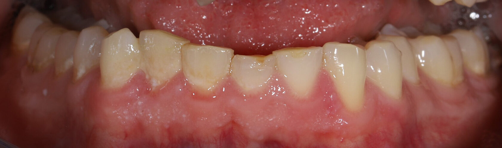 Совершенная улыбка благодаря винирам Emax