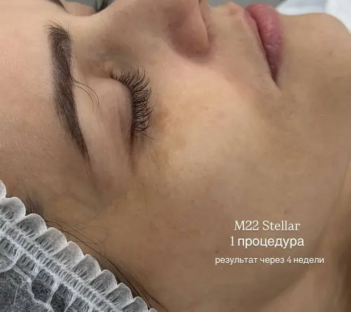 Пигментация на скуле, после
