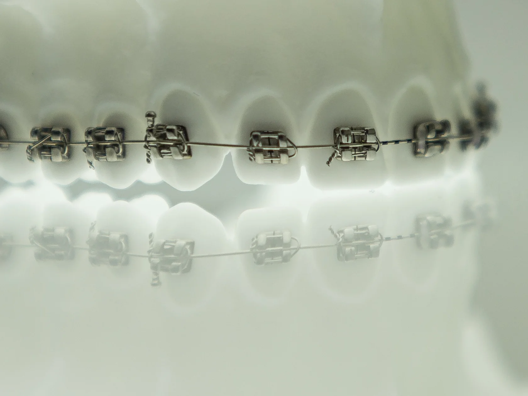 Металлические брекеты на модели зубов — современный вариант коррекции прикуса. Эффективное, долговечное и бюджетное решение, актуальное для обзора современных брекет-систем и выбора идеальной ортодонтической конструкции для красивой улыбки.