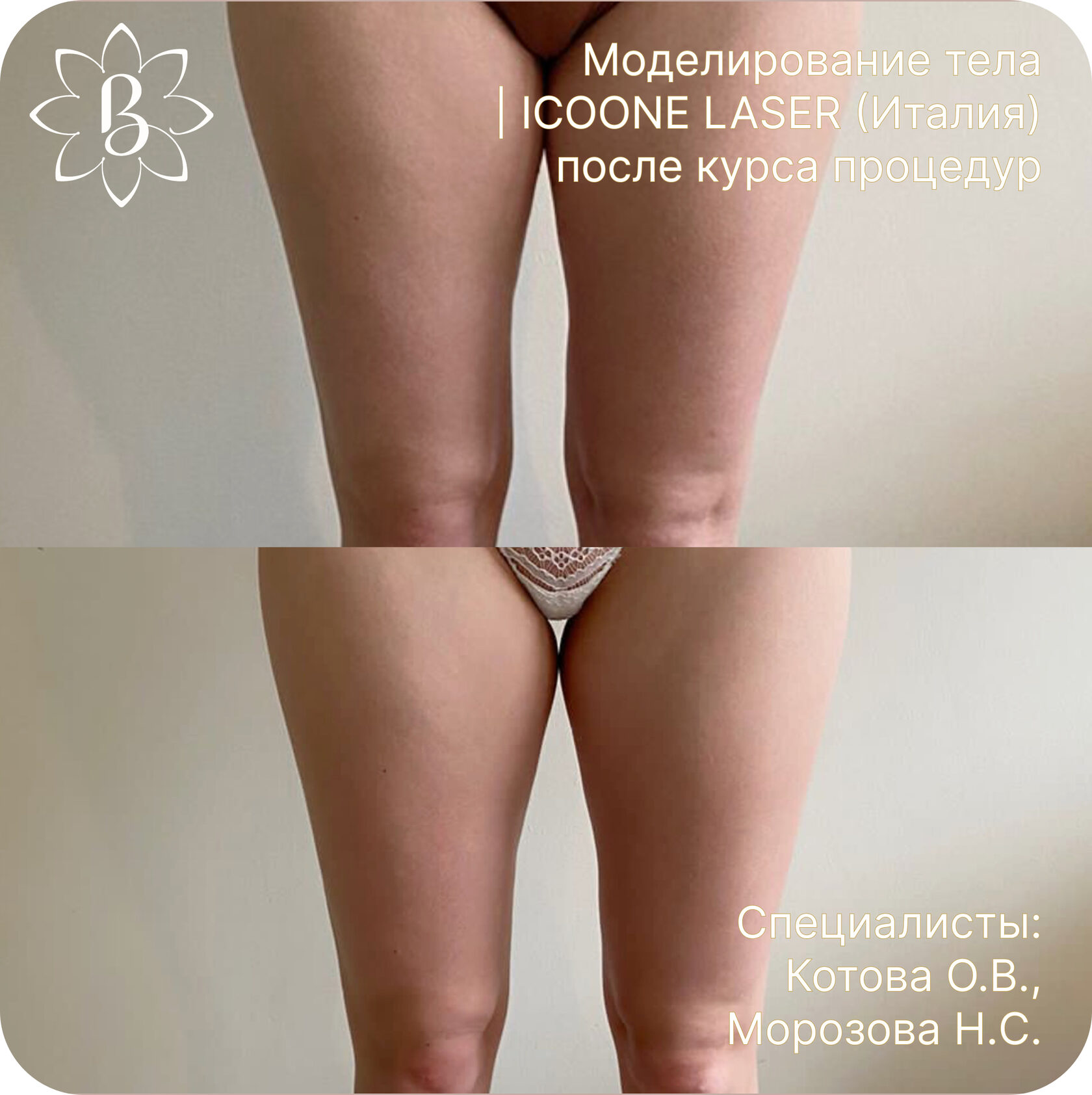 Диодная лазерная эпиляция СПб