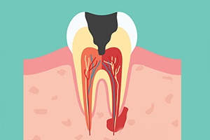 Причины столь долгого прорезывания зуба