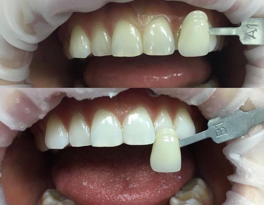 результаты отбеливания зубов до и после