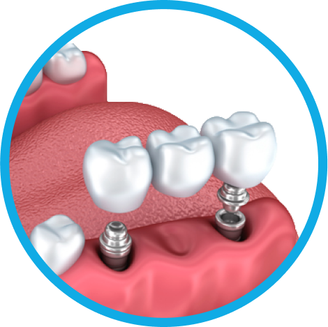 Установка имплантов в Дербенте. Имплантация при отсутствии одного зуба.