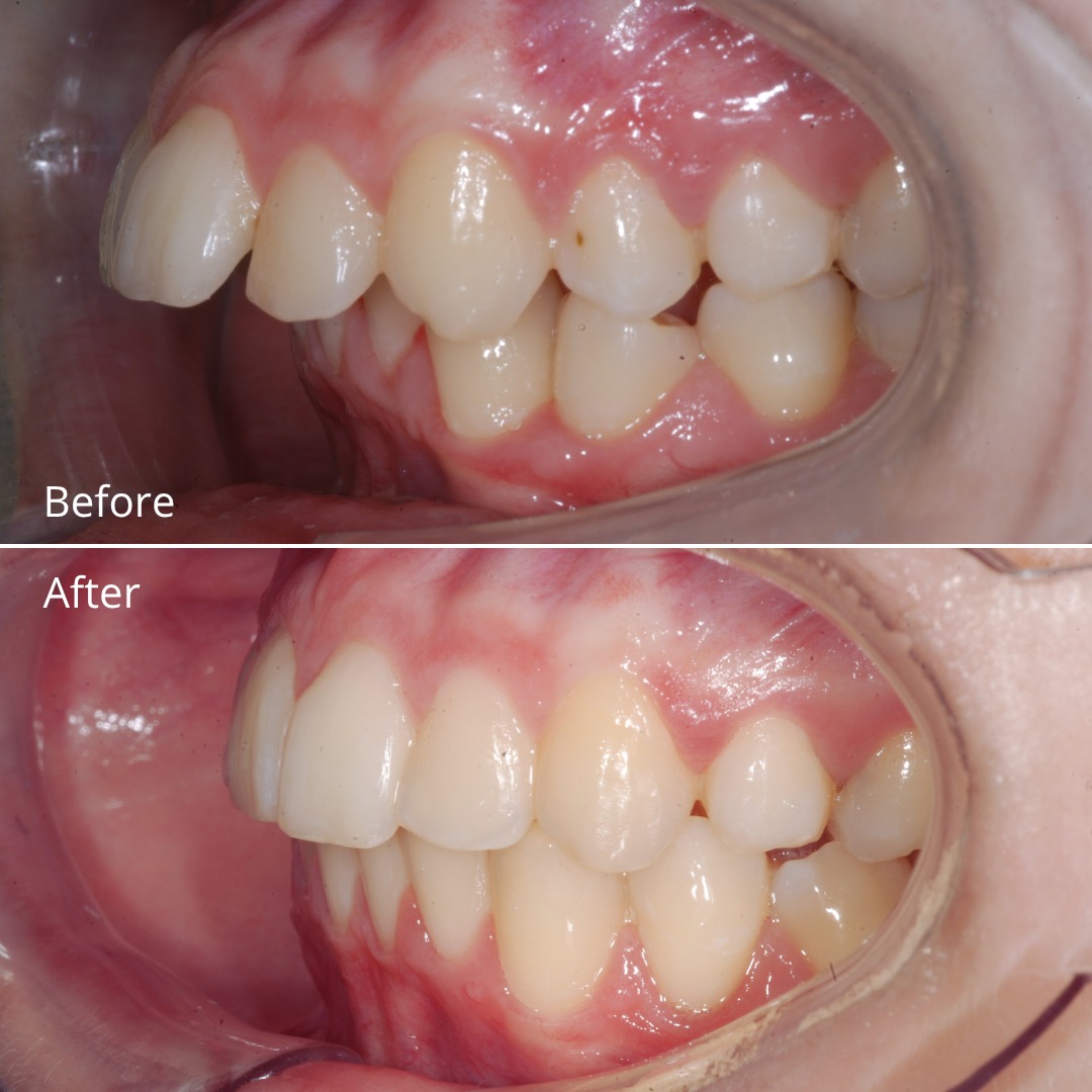Stage showing incisor retraction and bite deepening correction — photo 3 of 6