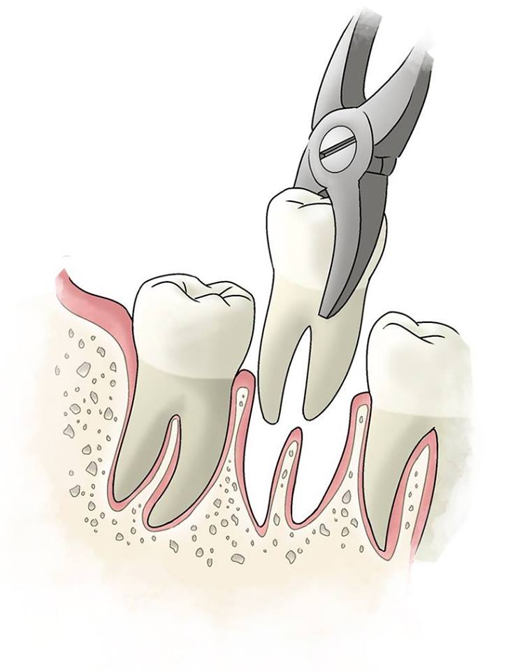Tooth extraction. Полуретинированный зуб мудрости.