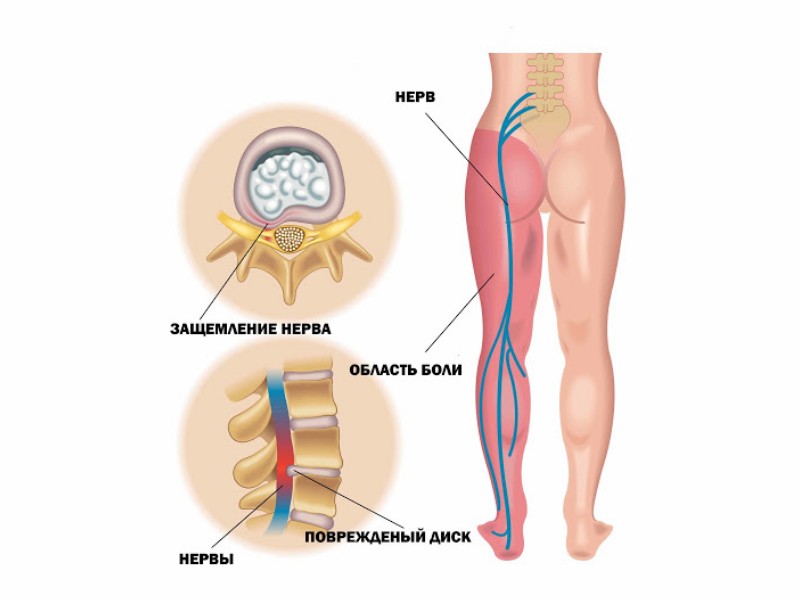 Межпозвоночная грыжа поясничного отдела отдает в ногу