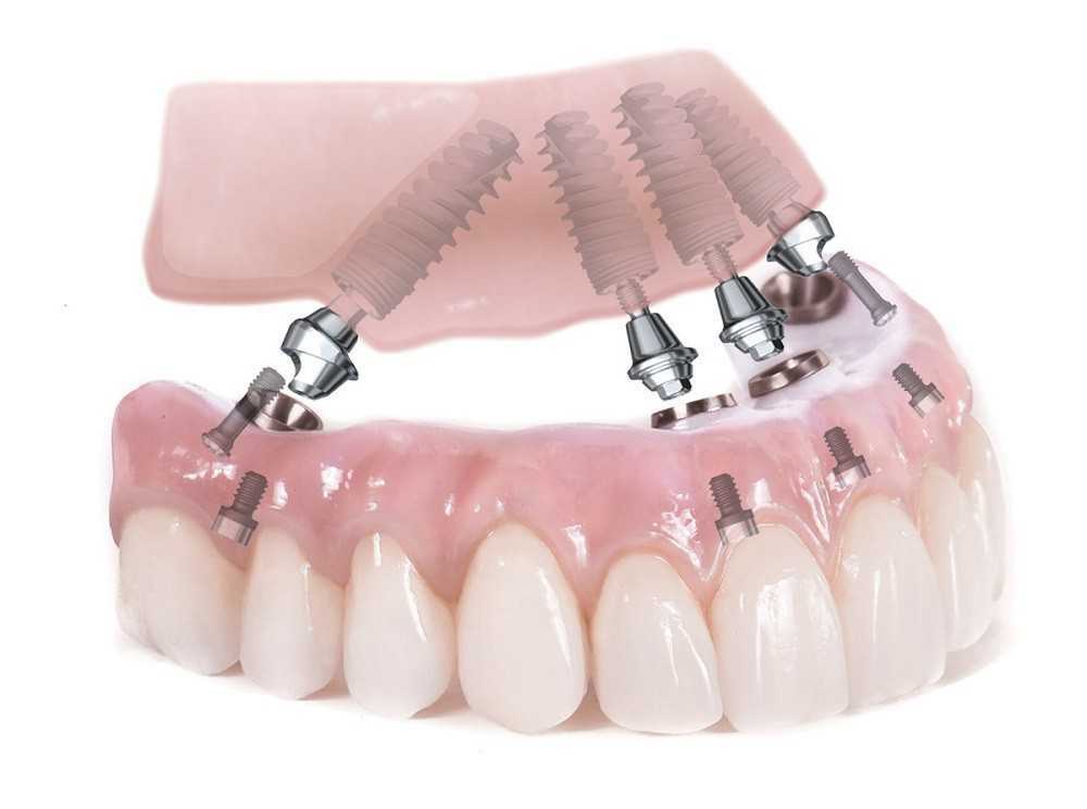 Имплант сразу после удаления зуба