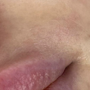 после лазерной эпиляции над губой