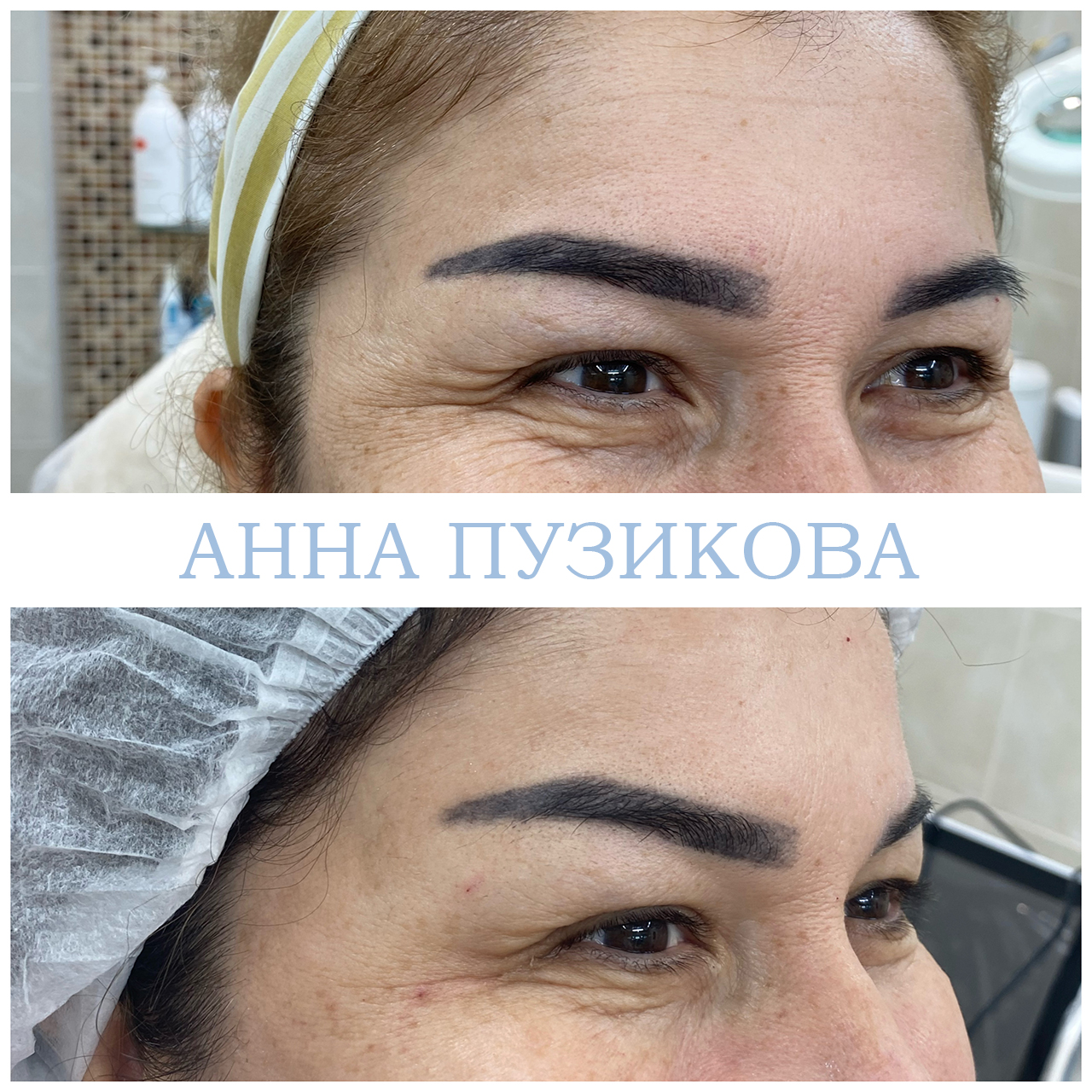 Результат ботулинотерапии — коррекция мимических морщин на лбу и в области глаз. Косметолог Пузикова Анна Анатольевна, Санкт-Петербург
