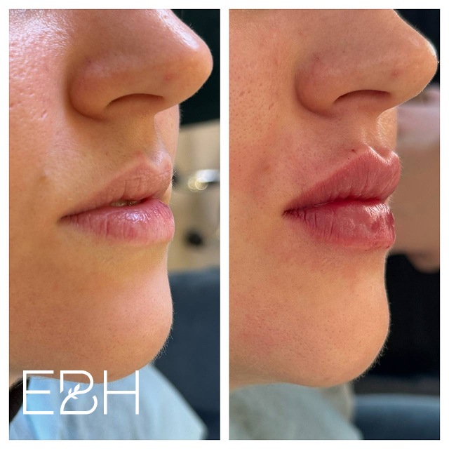 смас-лифтинг в москве на аппарате ультраформер