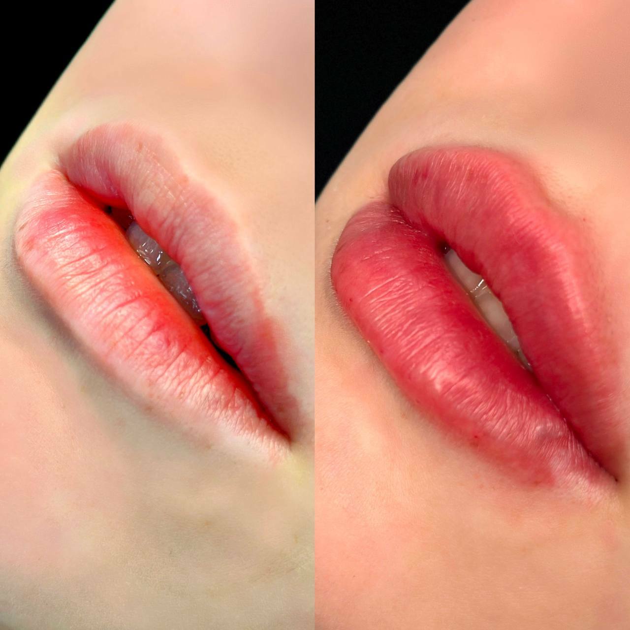 Увеличение губ, Можно ли сделать увеличение губ и коррекцию подбородка за  одну процедуру?