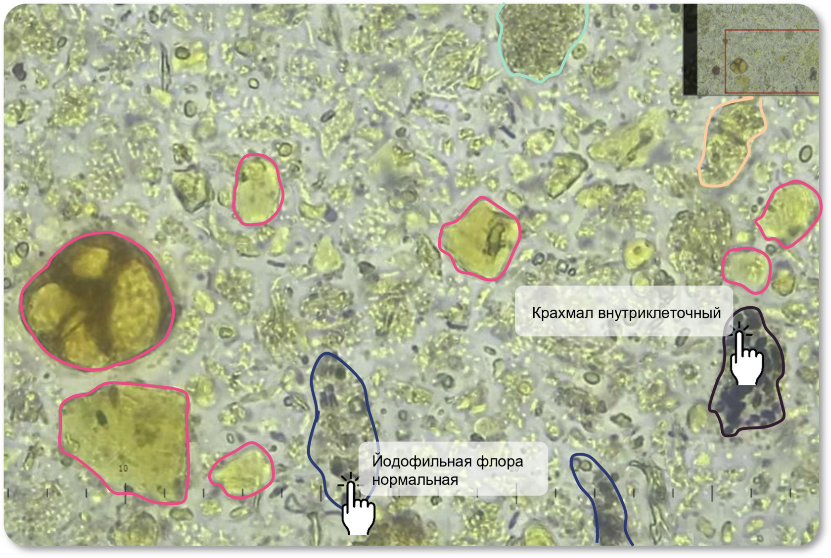 Определение внеклеточного крахмала в окрашенном Люголем препарате кала на снимке со станции Sciendox 2000R