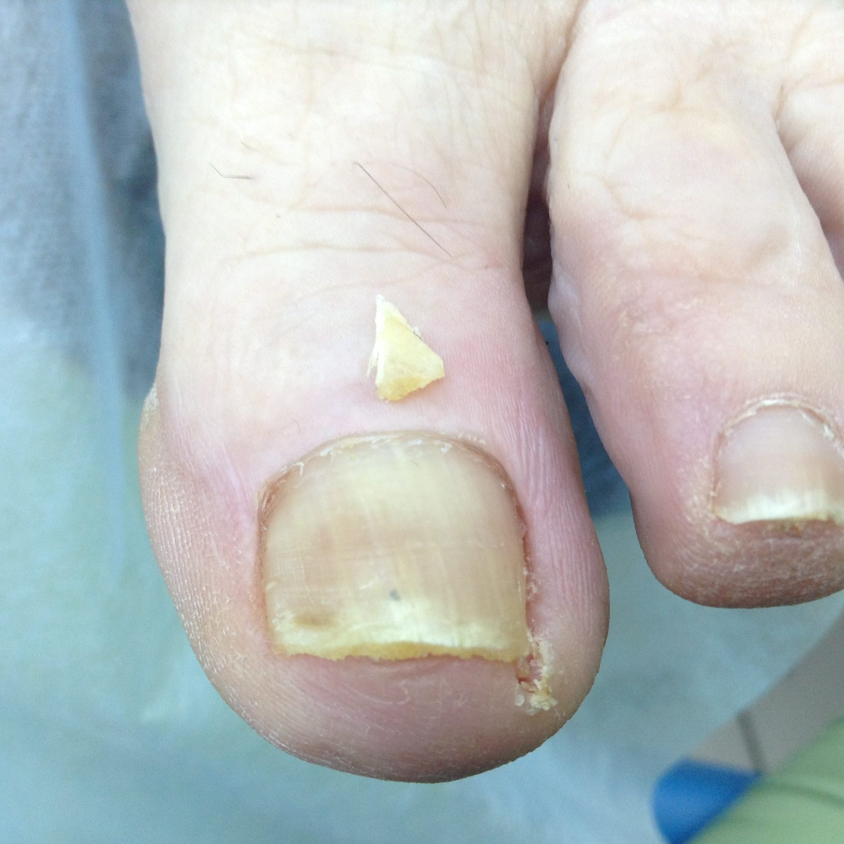 Избавление от вросших ногтей 