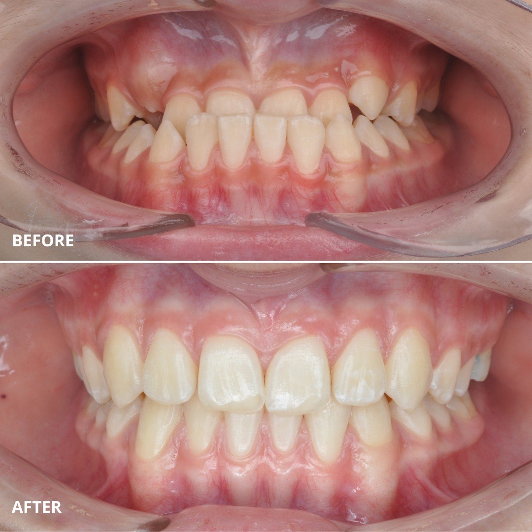 Stage photo showing progressive resolution of the anterior crossbite — photo 4 of 7