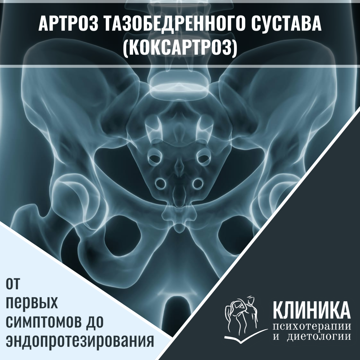 Артроз тазобедренного сустава (коксартроз): от первых симптомов до эндопротезирования