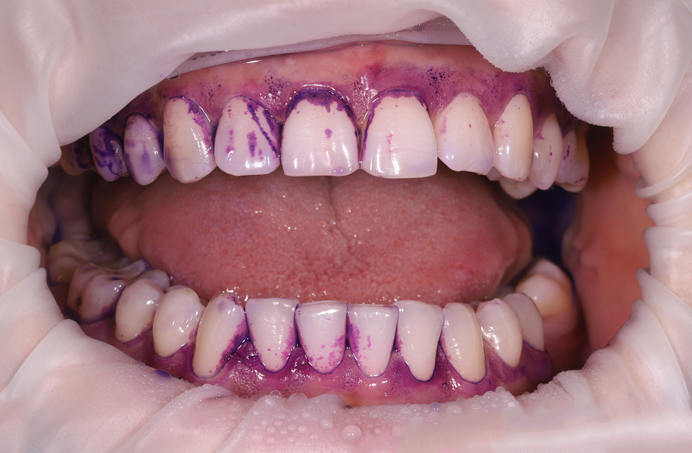 Комплексная гигиена полости рта