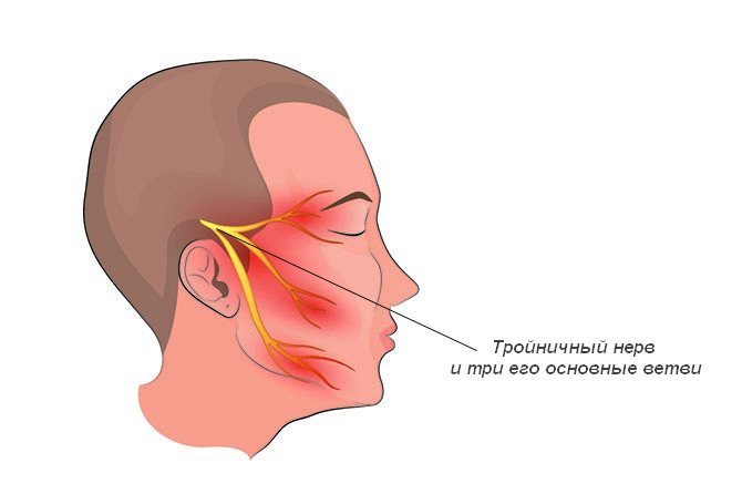Невралгия лицевого нерва