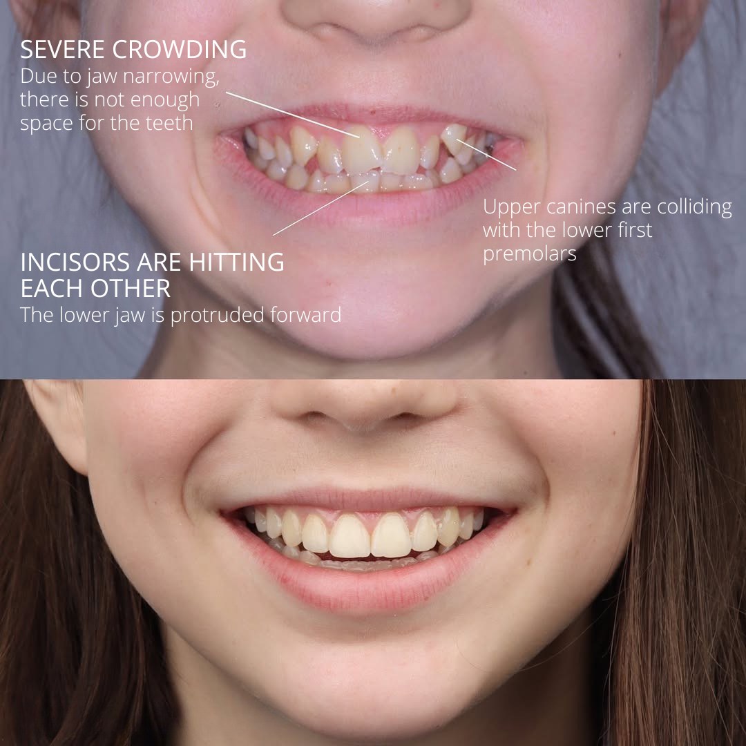 Detail view of the smile makeover progress during treatment — photo 2 of 3
