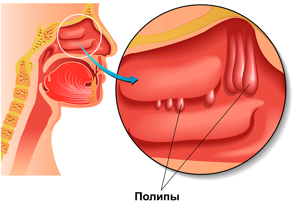 Полипы носа - причины, симптомы, диагностика и лечение