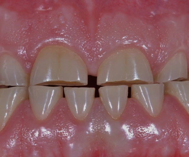 Бруксизм – что это, причины и лечение у взрослых, причины скрежета зубами