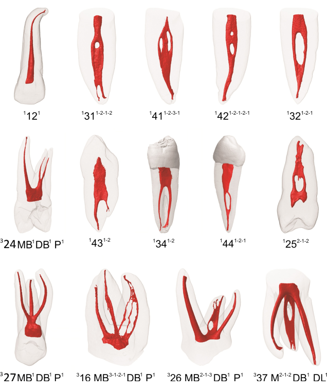 Пример разнообразия анатомии корневых каналов