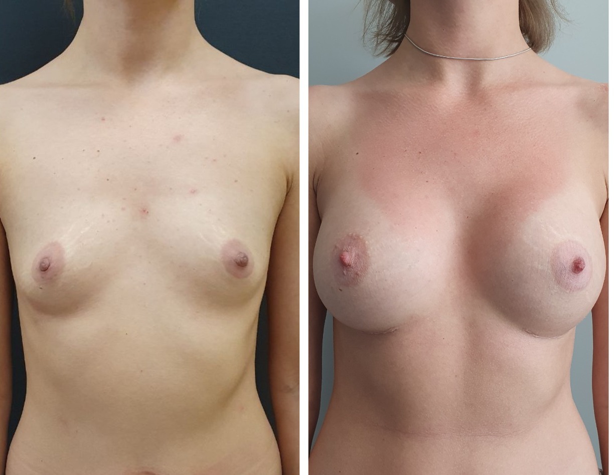 удаление и восстановление груди в одну операцию фото 94
