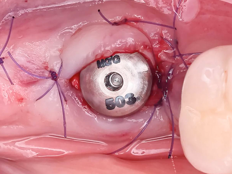 Установка формирователя десны AnyOne Onestage