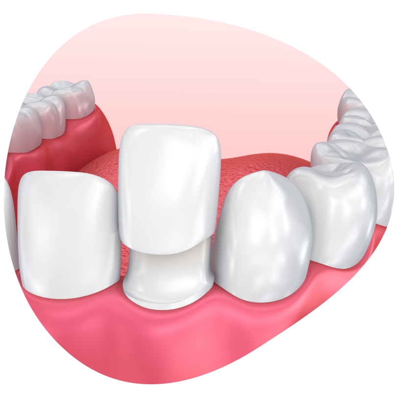 Протезирование зубов | Стоматология «АЛЕКСАНДРиЯ»