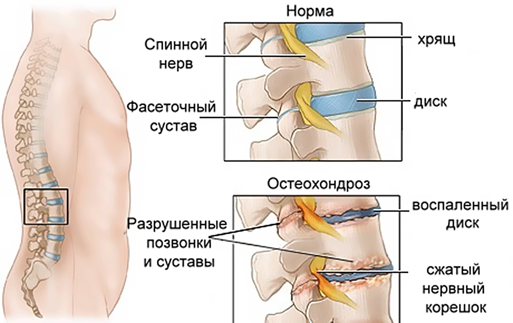 Подраздел 1.2: Профилактика остеохондроза шейного отдела позвоночника