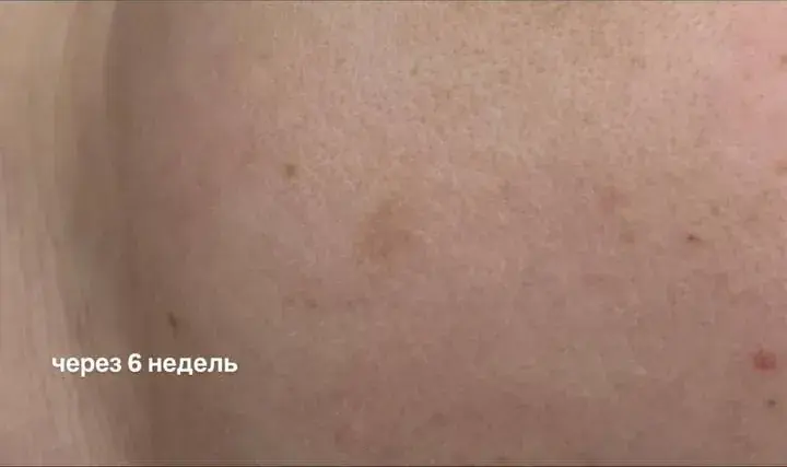 Пигментное пятно на коже, после