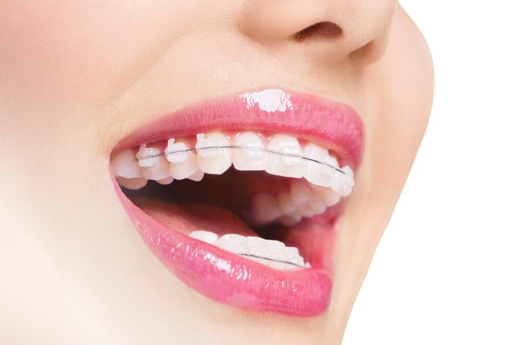 Ортодонтическое лечение