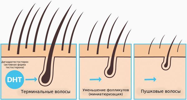 Миниатюризация волосяного фолликула и превращение терминальных волос в пушковые