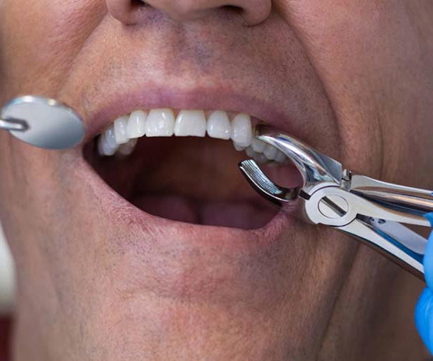 Удаление нерва в зубе - Вопросы-Ответы — Стоматология «Все свои!» — официальный сайт