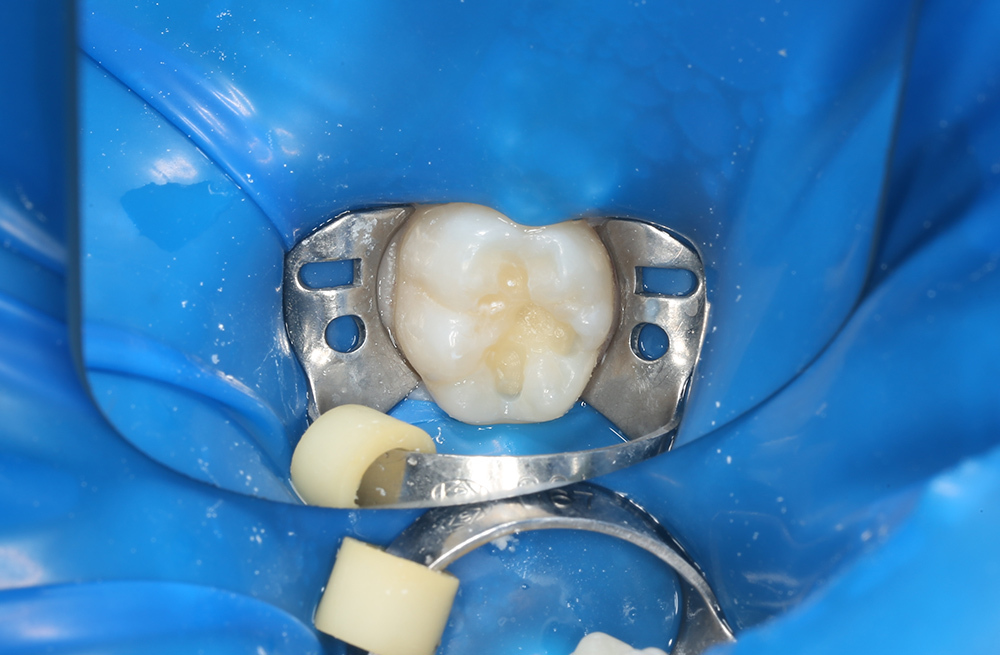 Композитная реставрация зуба при среднем кариесе у ребёнка школьного возраста