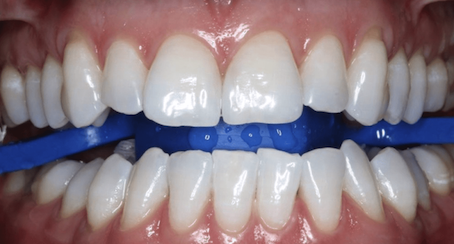 Отбеливание системой ZOOM4 в Москве – клиника Пробел