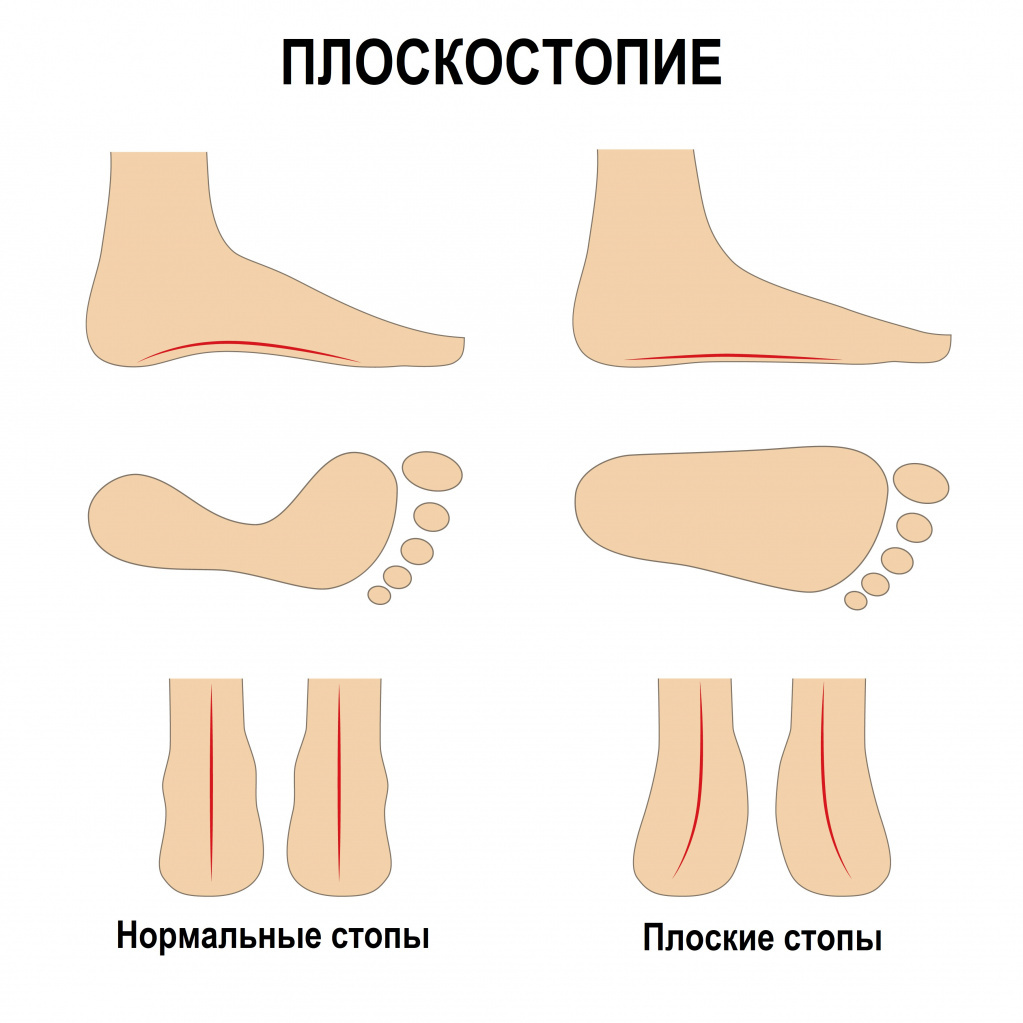 Дети с плоскостопием