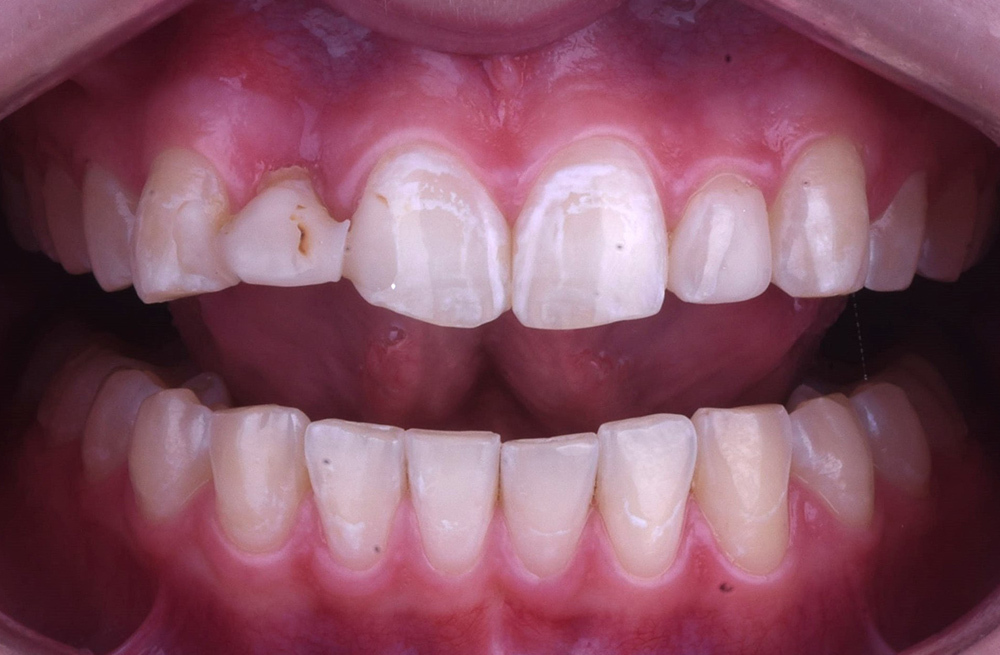 Эстетическая реставрация зуба композитным виниром и замещение отсутствующего зуба имплантом Straumann с циркониевой коронкой