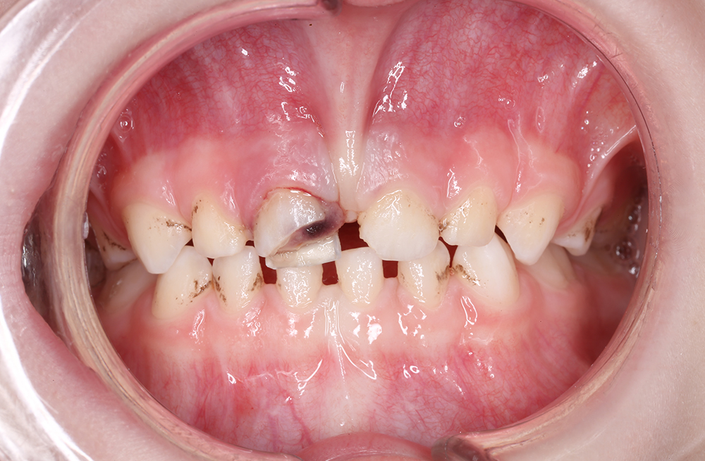 Удаление поврежденного зуба маленькому пациенту