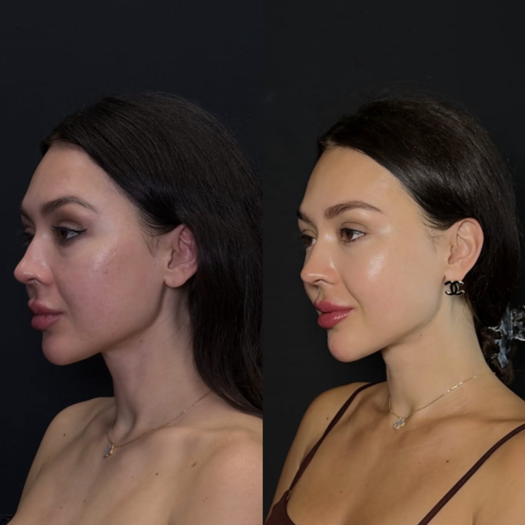 Сравнение до и после процедур клиники Skin Longevity: контур лица, качество и тон кожи