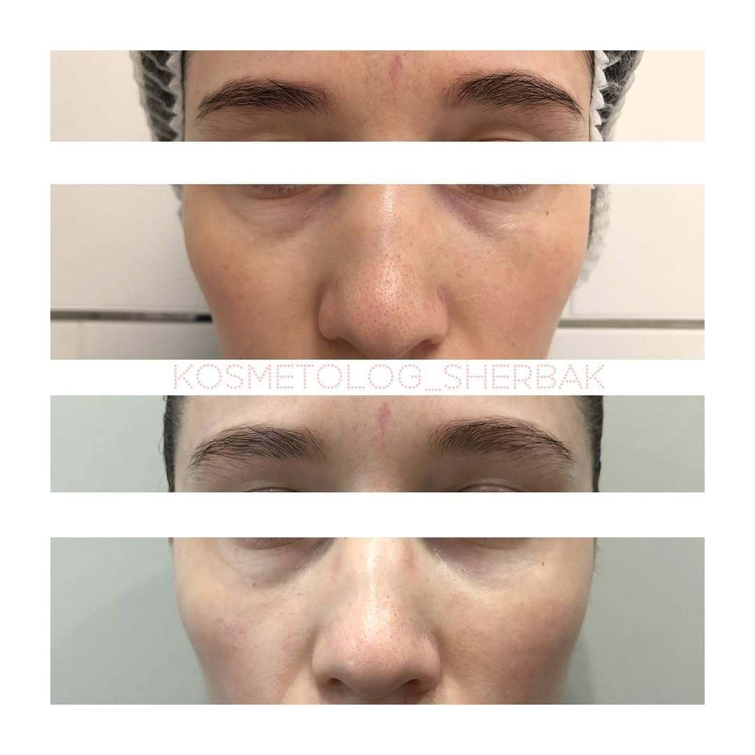 Контурная пластика лица в клинике PradusCOSMO, Санкт-Петербург. Естественный результат без эффекта переделанного лица