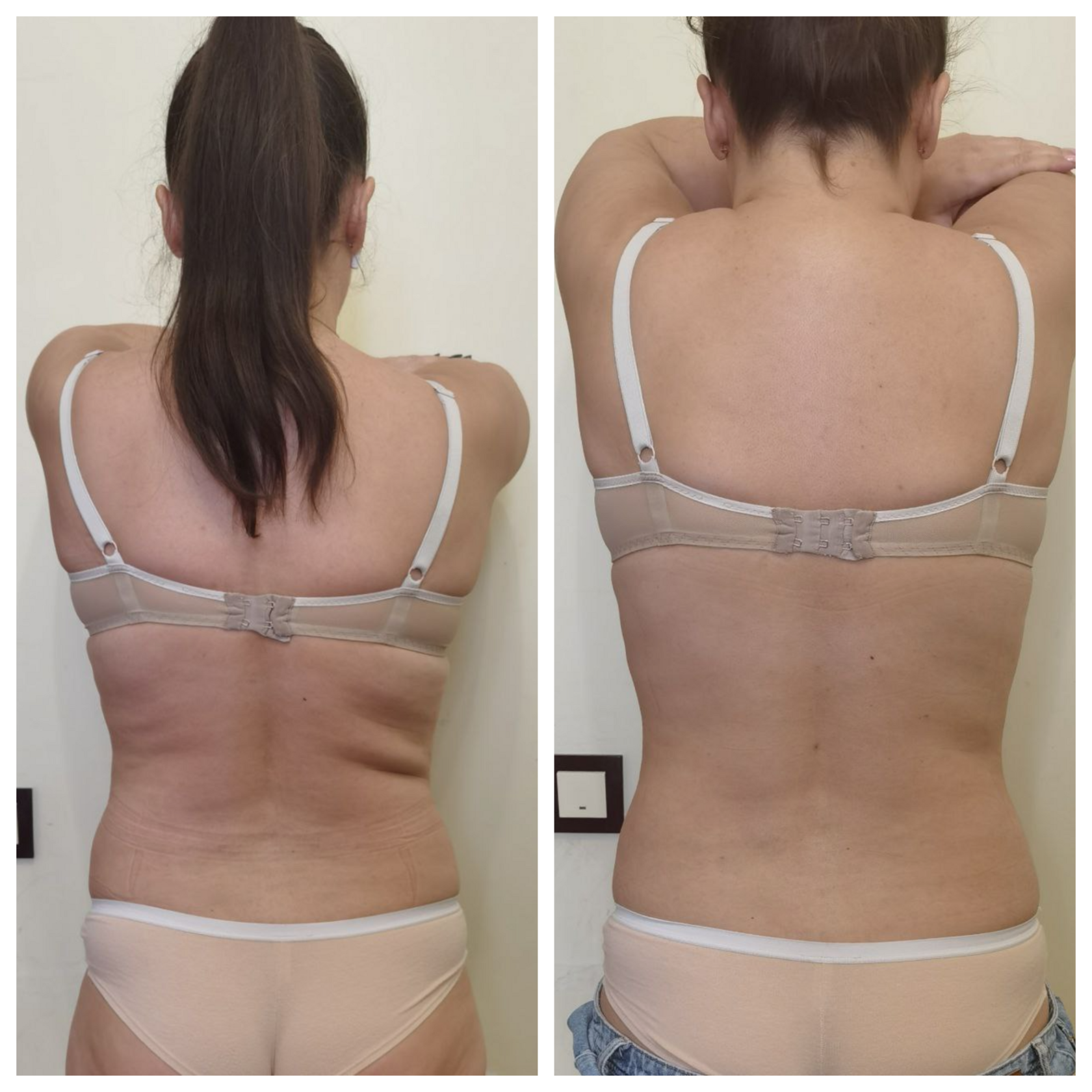 убрать живот и бока без операции