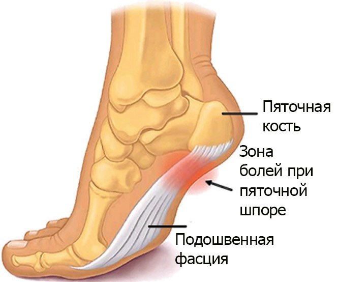 Стельки при пяточной шпоре