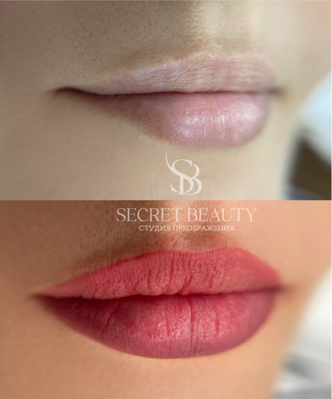 Фото губ до/после