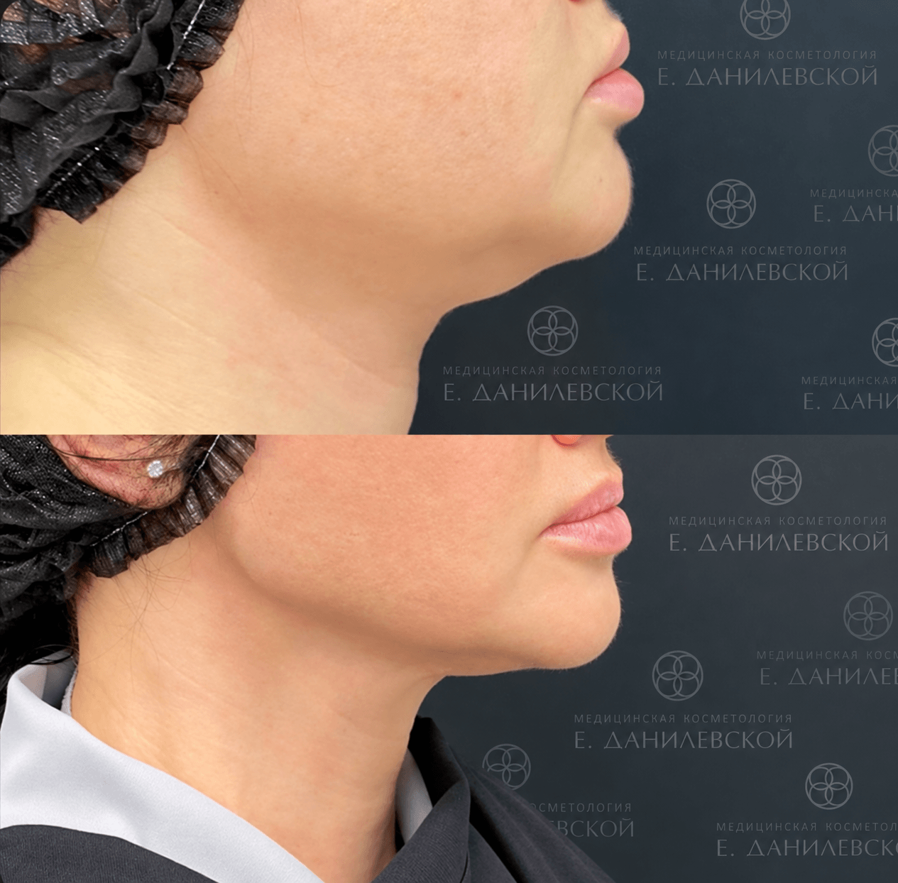 FaceTite до и после: коррекция второго подбородка у женщины