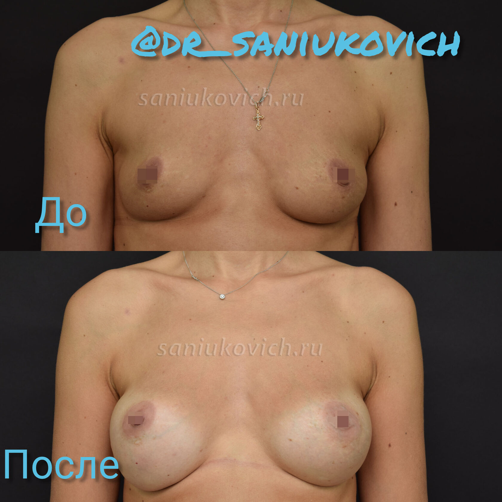 удаление импланта груди у женщин фото 110