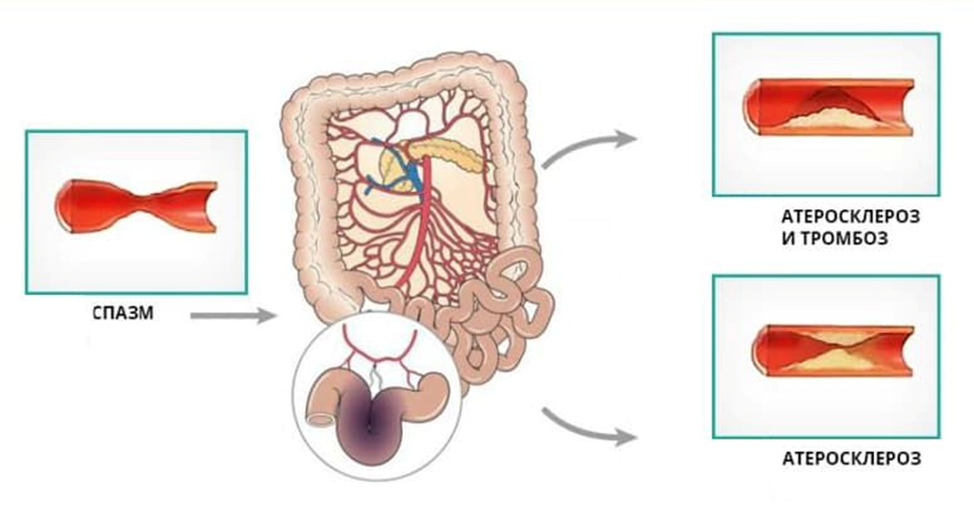 Мезентериальные  сосуды атеросклероз. Патогенез синдрома хронической абдоминальной ишемии. Симптом атеросклероза мезентериальных артерий. Хроническая мезентериальная ишемия.