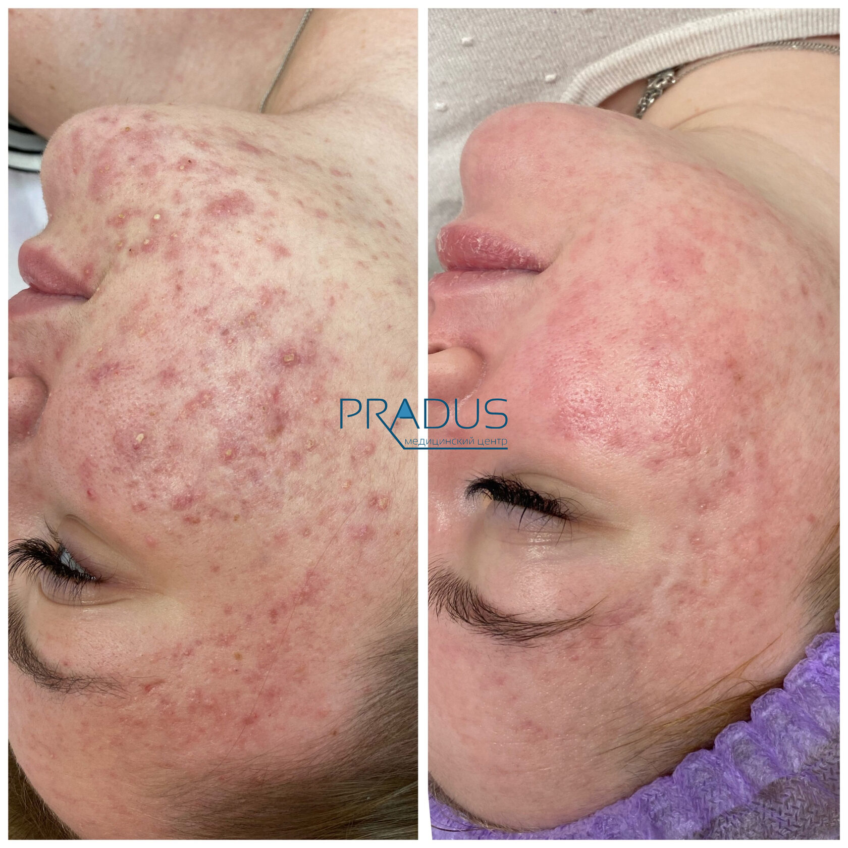 Лечение акне у женщины в клинике PradusCOSMO, СПб. До и после процедуры