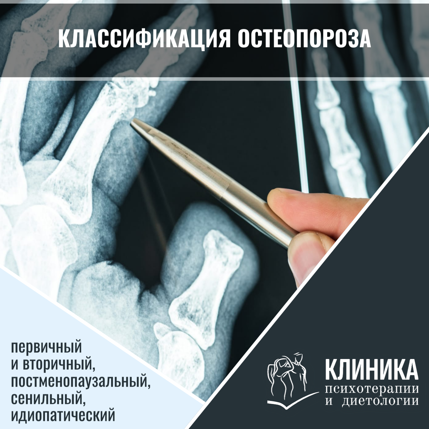 Классификация остеопороза: первичный и вторичный, постменопаузальный, сенильный, идиопатический