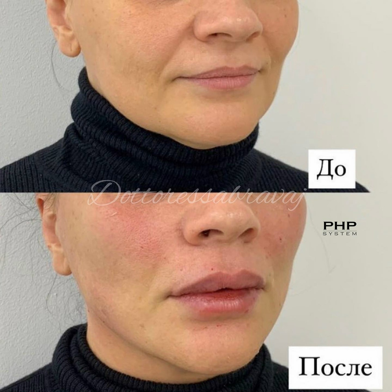 Результат процедуры в PHP Косметология — до и после