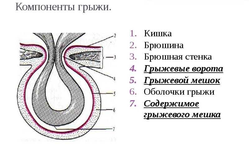 Пупочная грыжа рисунок схема